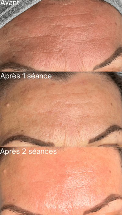 Lifting coreen fos sur mer