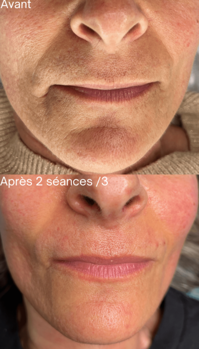 fils de soie et collagene 13