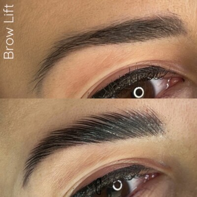 brow lift martigues