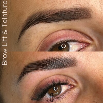 brow lift istres