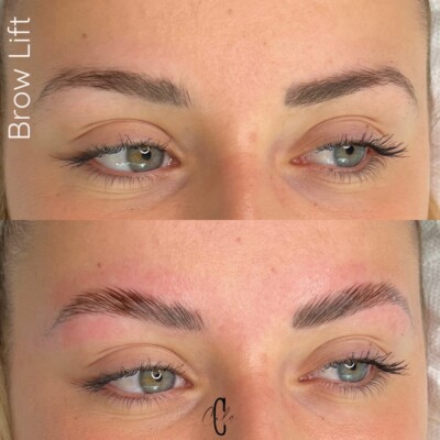 brow lift aix