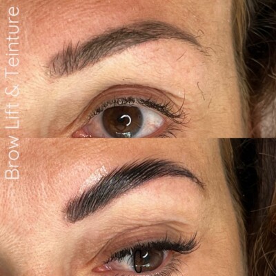 brow lift carry