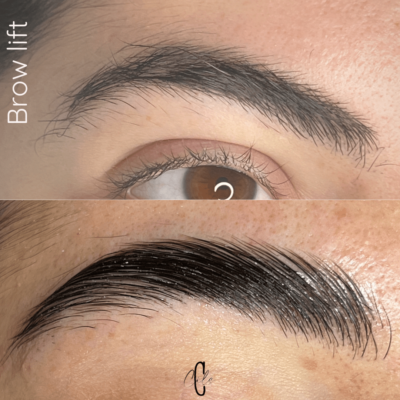 brow lift aix