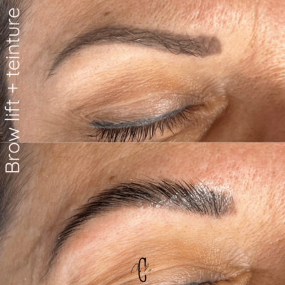 brow lift