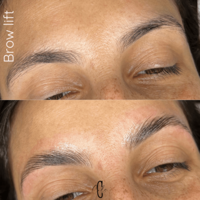 brow lift istres