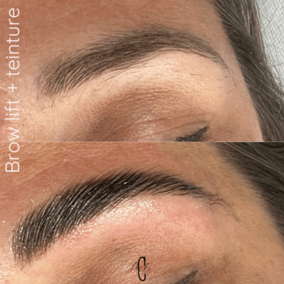 brow-lift-aix-en-provence brow-lift-aix-en-provence