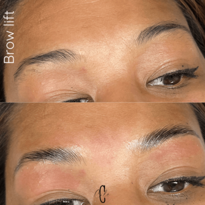brow lift port saint louis